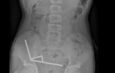 13-year-old boy hospitalized, loses part of intestine after swallowing powerful magnets