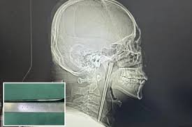 Man lives for 8 years with metal chopstick lodged in his throat after drunken incident